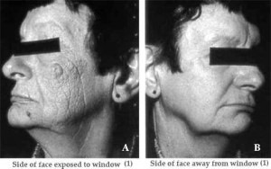 UV Damage to Left Face via Office Window